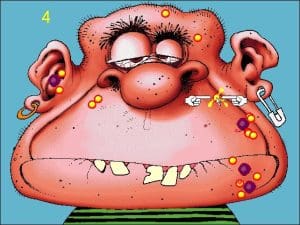 Acne Attack Gameplay (Windows)